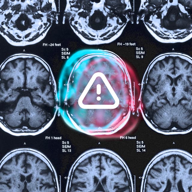 Invisible Concussion MRI scan illustration